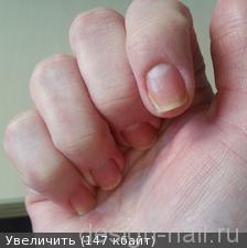 Проблема с ногтями