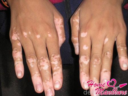 Распространенные кожные заболевания рук