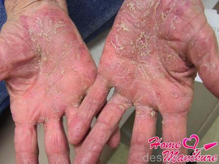 Распространенные кожные заболевания рук
