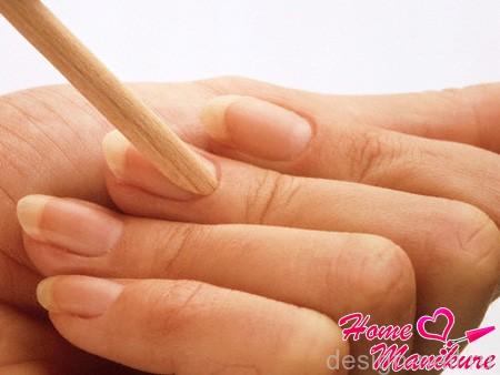 Как избавиться от птеригия на ногтях?