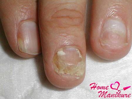 Причины и способы лечения онихолизиса ногтей