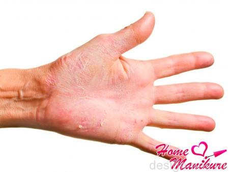 Почему трескается кожа на пальцах рук?